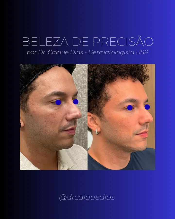 Dr. Caíque's Beleza de Precisão post: before and after of a male patient in profile, with the eyes covered