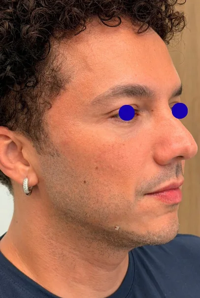 After: 45-degree view of a male patient's face, with the eyes covered