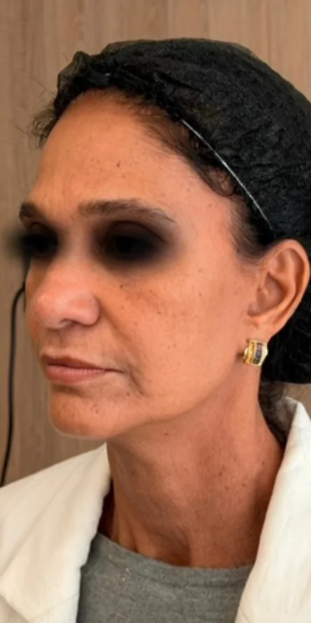 Antes: rosto de três quartos de uma paciente, com os olhos cobertos