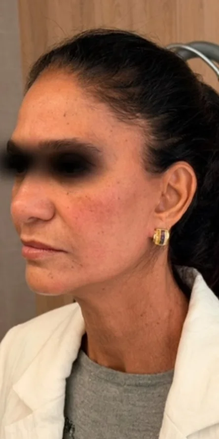 Depois: rosto de três quartos de uma paciente, com os olhos cobertos