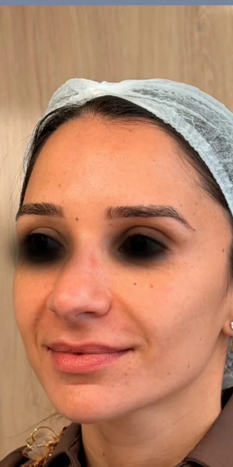 Antes: rosto de três quartos, com os olhos cobertos