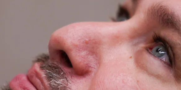 Before: nose profile of a male patient