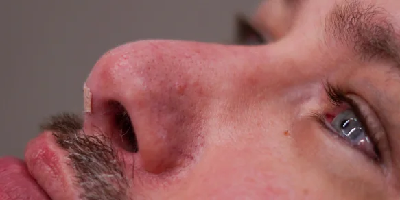 After: nose profile of a male patient