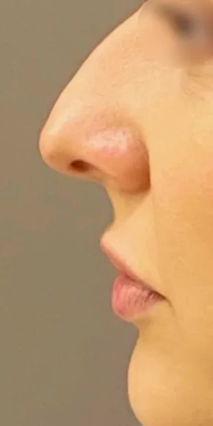Before: nose profile of a female patient