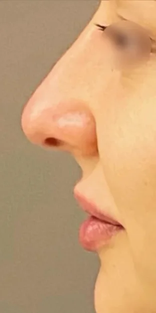 After: nose profile of a female patient
