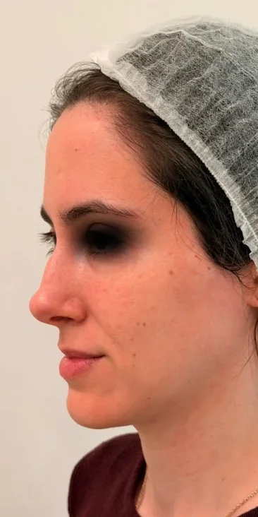 Before: profile of a female patient's face, with the eyes covered
