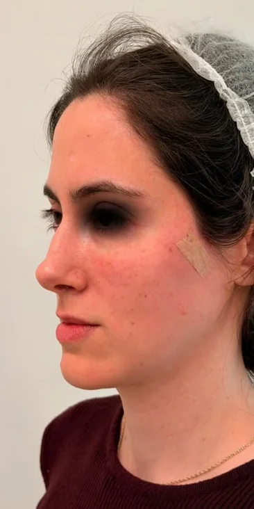 After: profile of a female patient's face, with the eyes covered